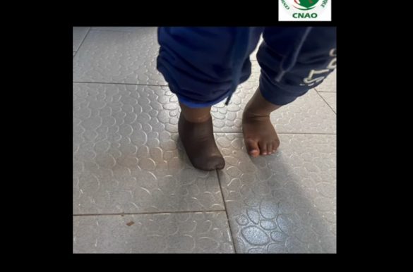 Fabrication Prothèse membre inférieur pour Enfant